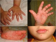 How Long Does Hand Foot And Mouth Disease Last In Adults At David 